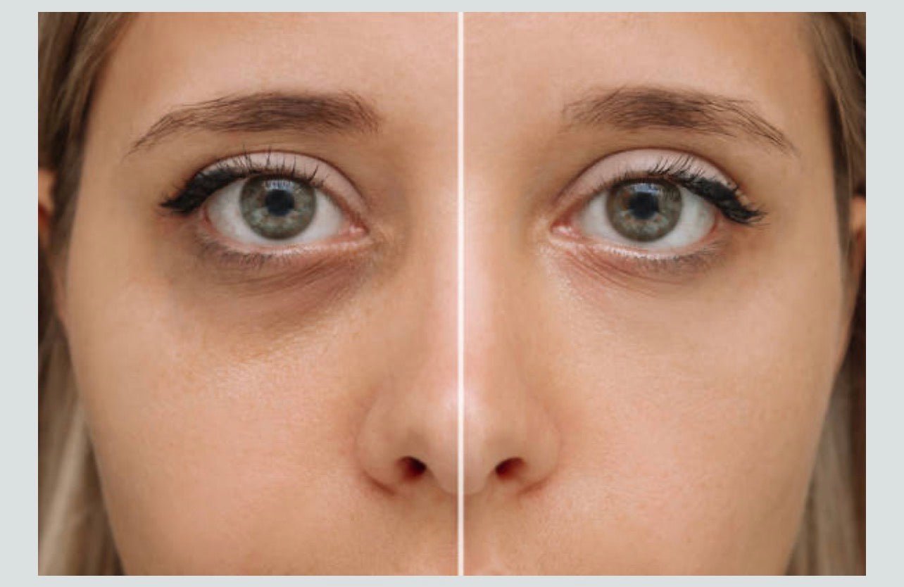 Cernes bleus ou marrons : Comment les reconnaître et enfin s’en débarrasser ? - My beauty